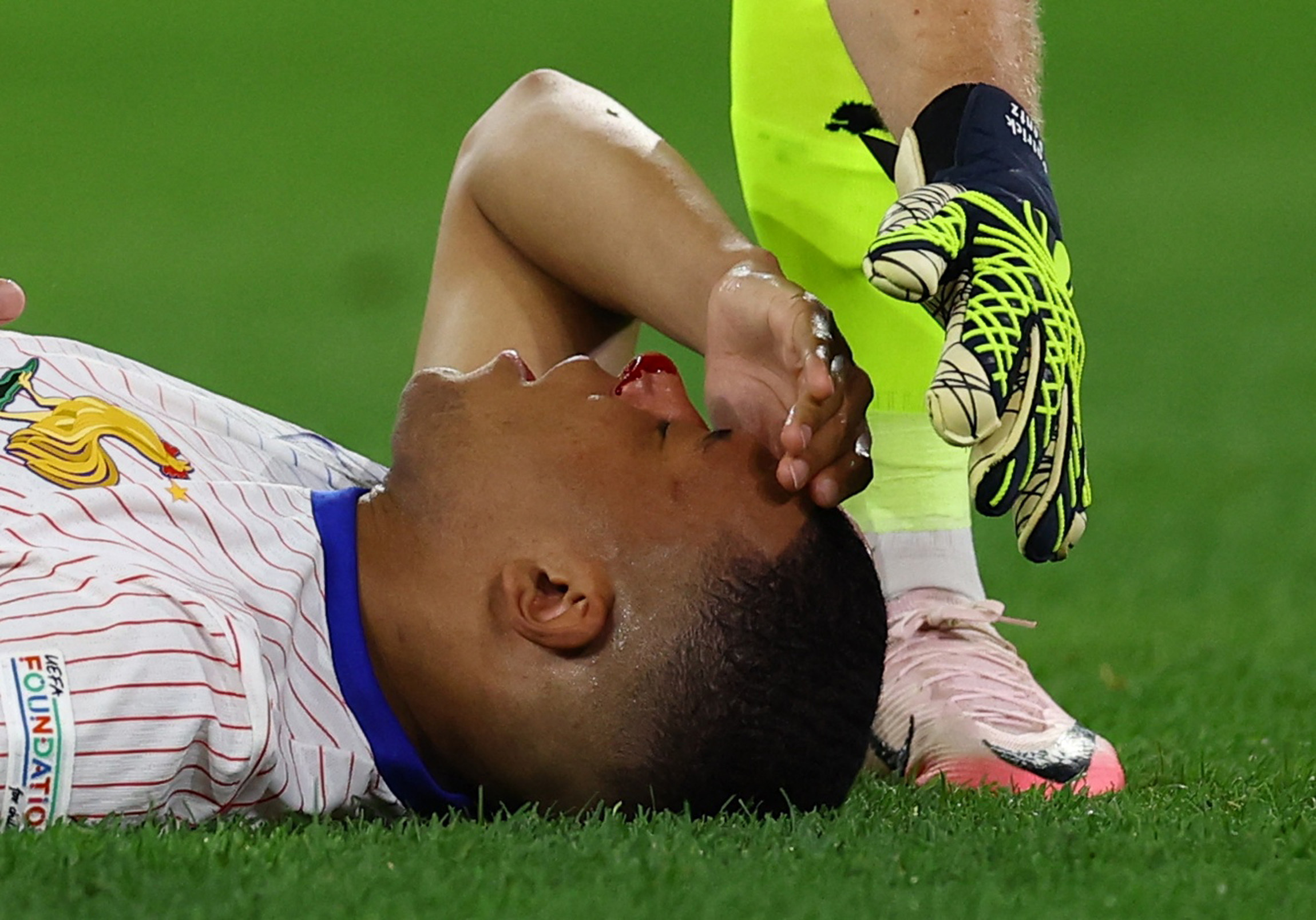 Kylian Mbappe was left covered in blood after a clash on the pitch against Austria